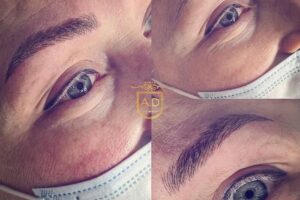 Alexandra Decu Profesional Hyaluron PenPlasma Pen Cursuri