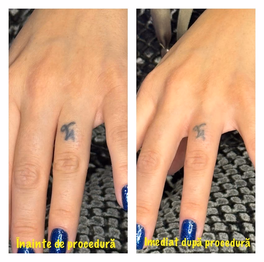 Bh Body Studio Epilare Definitiva Remodelare Corporala Militari Residence Chiajna