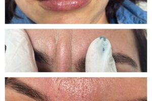 Epilare Definitiva Laser Tg Carbunesti