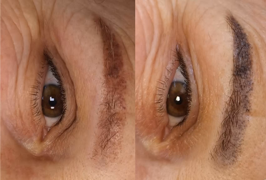 Indepartare tatuaje Bacau