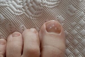 Pedichiură medicală Ploiești Podologie